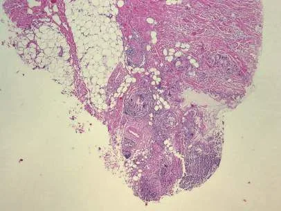 Corte histológico a bajo aumento teñido con hematoxilina-eosina de una reacción granulomatosa a gel de poliacrilamida. Se ven grandes vacuolas ópticamente vacías correspondientes al gel, rodeadas de bandas fibrosas eosinófilas y de infiltrado inflamatorio, con tejido adiposo residual entre los tabiques. El material no está encapsulado en un nódulo único sino disperso entre los lobulillos, y por eso la extracción completa es imposible. Cosmetic Medicine and Surgery 2016, figura 56.8.